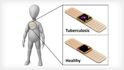 New Global Health Solutions: An Adhesive That Can Diagnose Tuberculosis